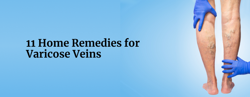 11 Home Remedies for Varicose Veins