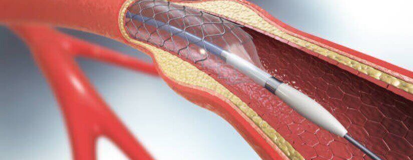 Steps to a Speedy Vascular Surgery Recovery