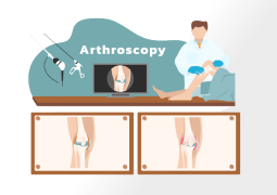 Things You Should Know About Arthroscopic Knee Surgery