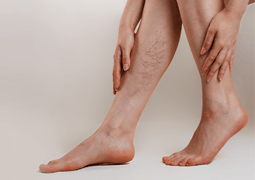 Varicose veins