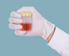 Blood in Urine (Hematuria) 