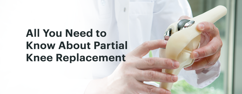 All You Need to Know About Partial Knee Replacement