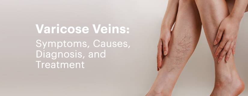 Varicose veins: Symptoms, Causes, Diagnosis, and Treatment