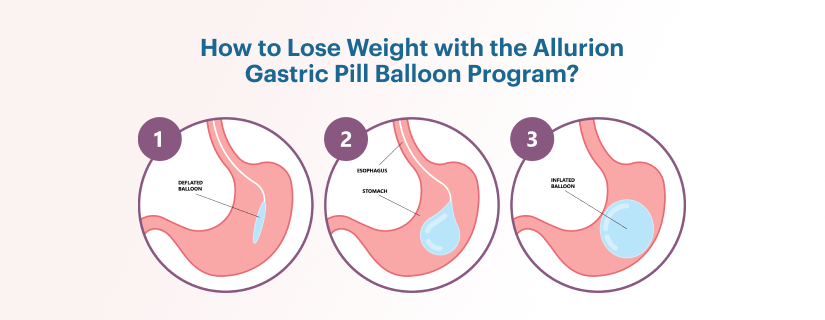 How to Lose Weight with the Allurion Gastric Pill Balloon Program
