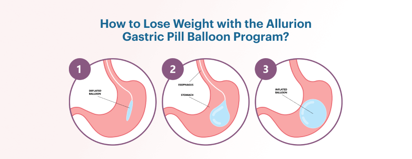 كيفية إنقاص الوزن باستخدام برنامج Allurion Gastric Pill Balloon