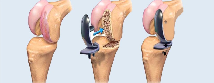 How to Prepare for a Joint Replacement Surgery?