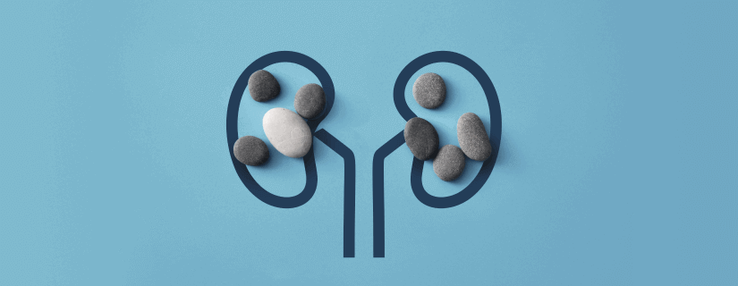 3 Kidney Stone Warning Signs You Should Never Ignore