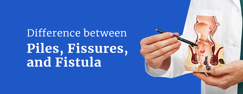 Difference between Piles, Fissures, and Fistula