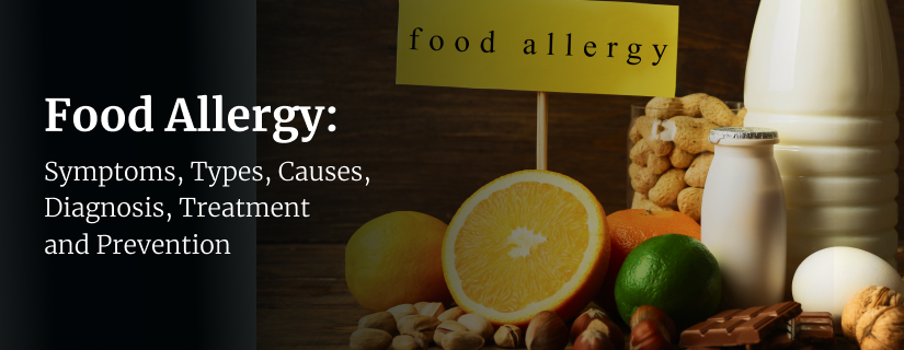 Food Allergy: Symptoms, Causes, Diagnosis, Treatment and Prevention