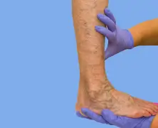 Radiofrequency (RF) Ablation Treatment for Varicose Veins: Know More 