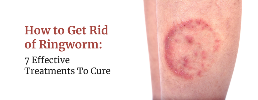 How to Get Rid of Ringworm: 7 Effective Treatments To Cure