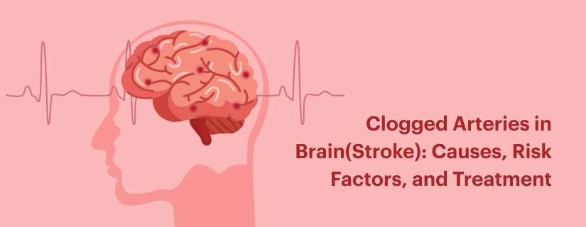 Xididdada Xiran ee Maskaxda (Stroke): Sababaha, Waxyaabaha Khatarta ah, iyo Daaweynta