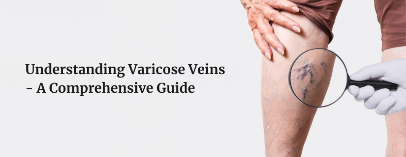 Exercise Guide for Varicose Veins