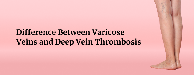 Difference Between Varicose Veins and Deep Vein Thrombosis