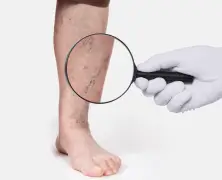 Varicose Vein Endovenous Laser Ablation (EVLA)