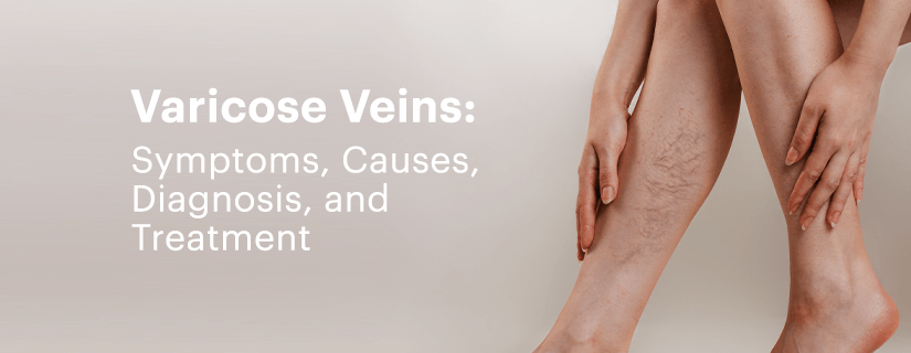 Varicose veins