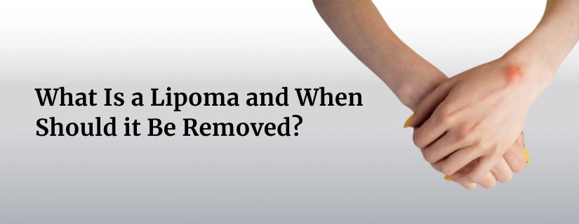 What Is a Lipoma and When Should it Be Removed?