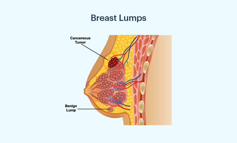 https://www.carehospitals.com/ckfinder/userfiles/images/breast-lumps.png