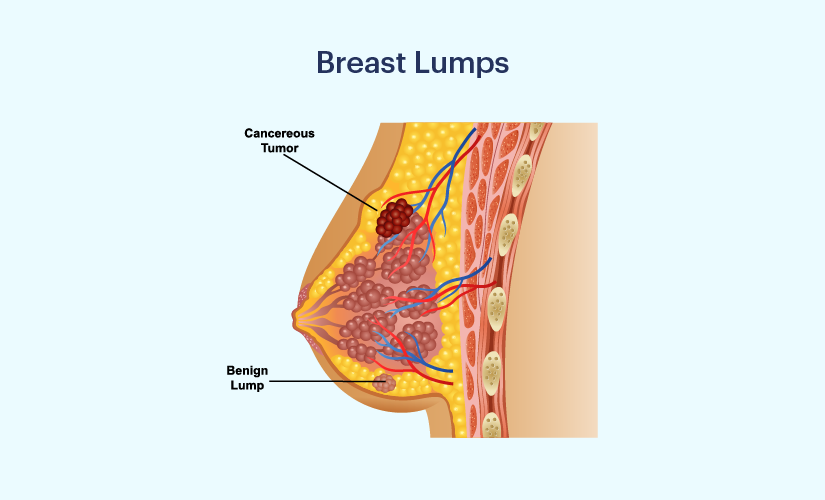 Breast Cysts: Types, Causes, and Treatment