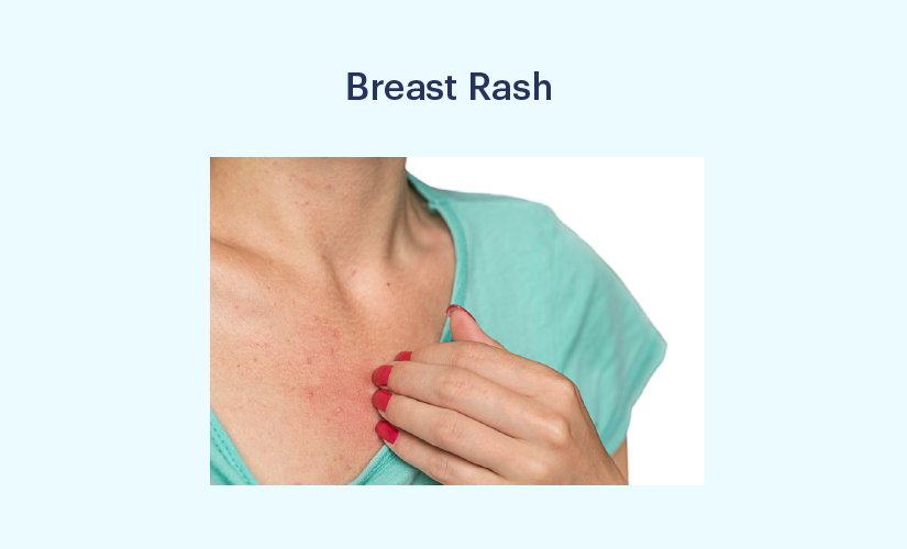 Itchy rash/hives on breast
