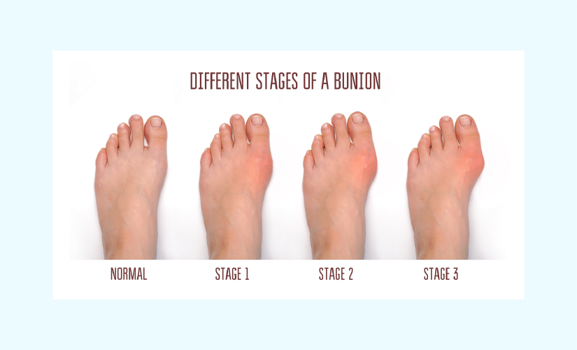 6 Exercises to Treat Bunion  Australian Healthcare Supplies