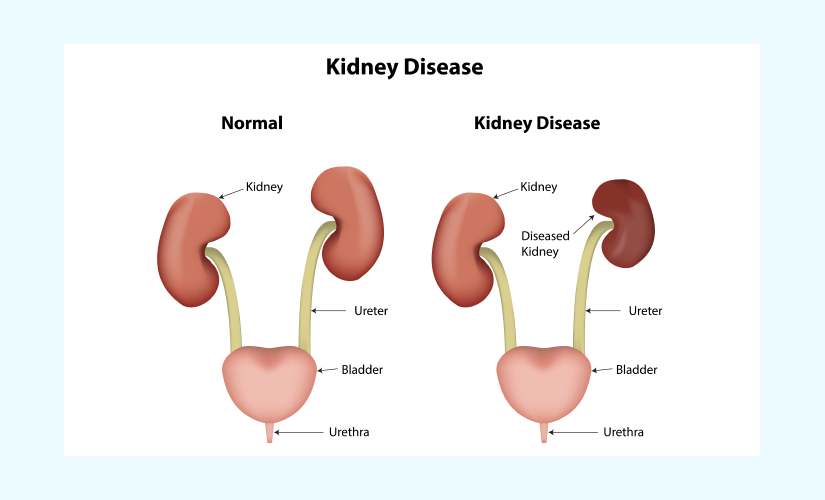 Creatinine Blood Test: Purpose, Preparation, Normal Range and Test ...