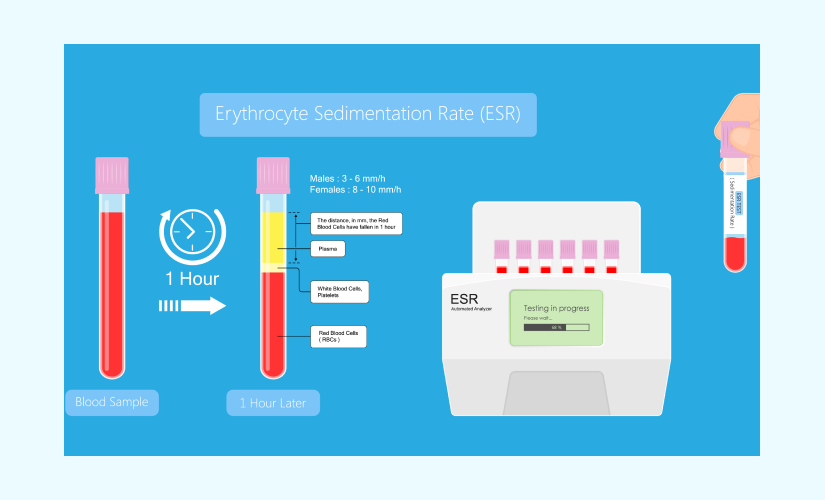Erythrocyte Sedimentation Rate (ECR) Test: Purpose, Procedures and Test  Results