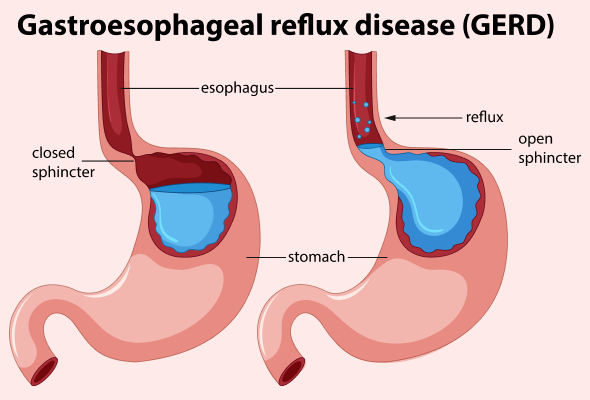Gastroesophageal Reflux Disease (GERD): Symptoms, Causes, Diagnosis and  Treatment