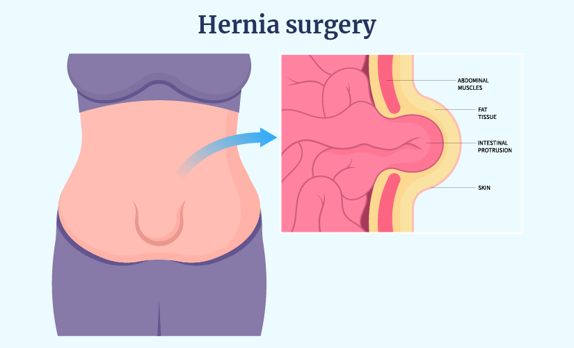 Abdominal Hernia – Gastroenterologist Hyderabad