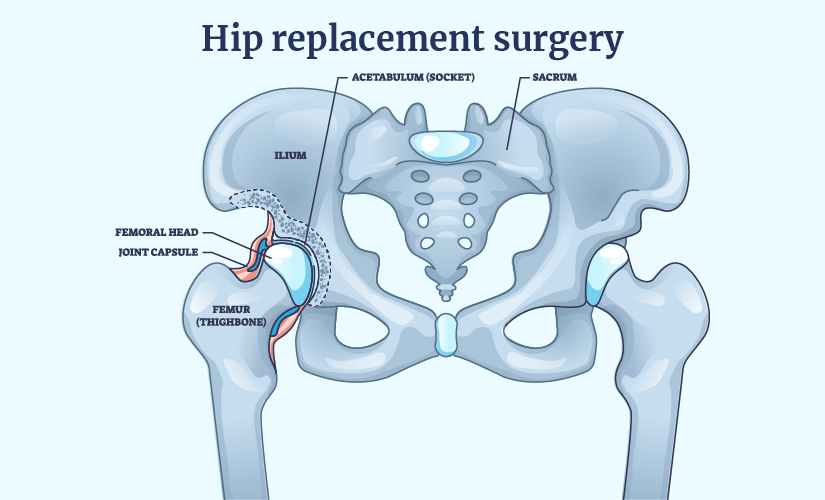 The Impact of Potential ORADEs on Length of Stay in Hip