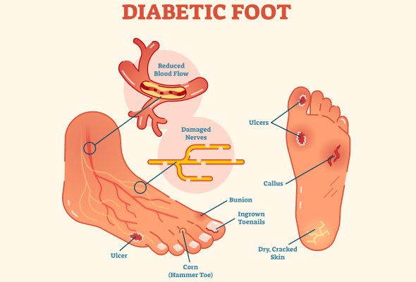 myths misbeliefs about diabetic foot ulcer