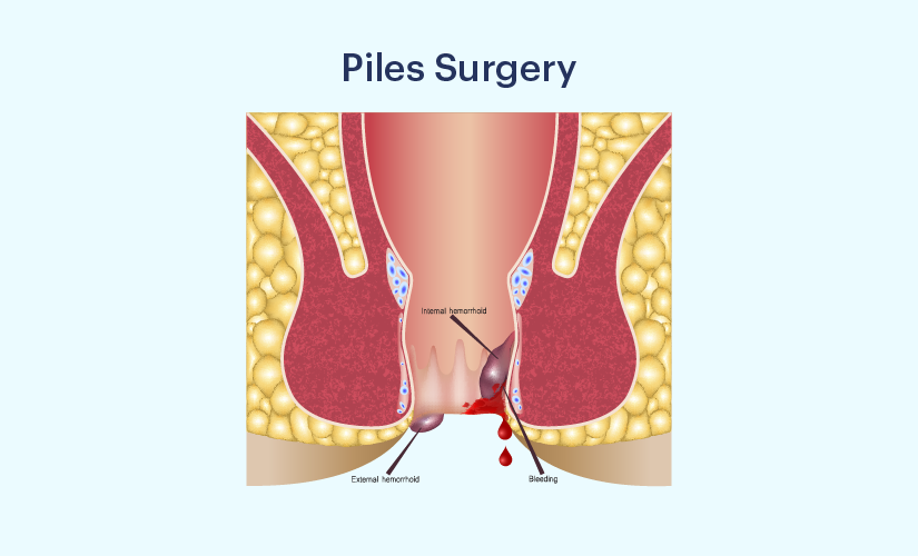 Kelina Hospital - PAINLESS PILES OPERATION Piles are also