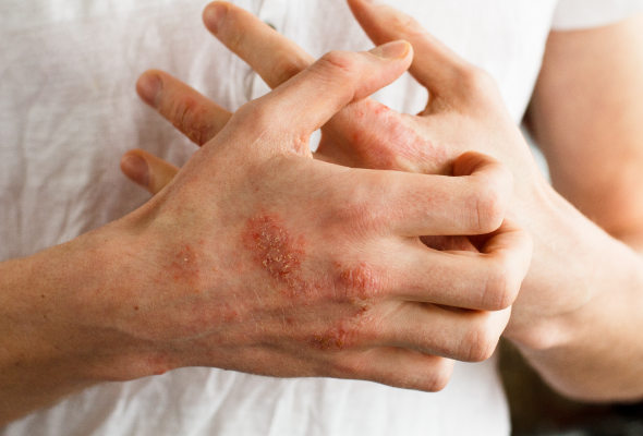 Poison Ivy: Symptoms, Rash, Treatment, and More