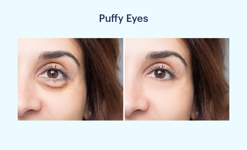 Puffy Eyes: Symptoms, Causes, Diagnosis, Treatment and Home Remedies
