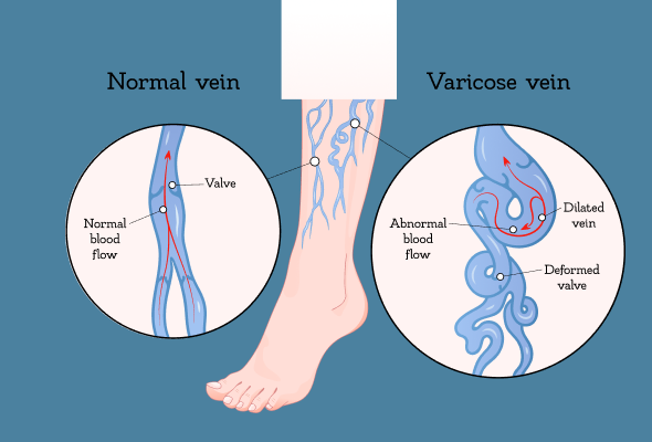 How to Treat Varicose Veins Without Surgery?