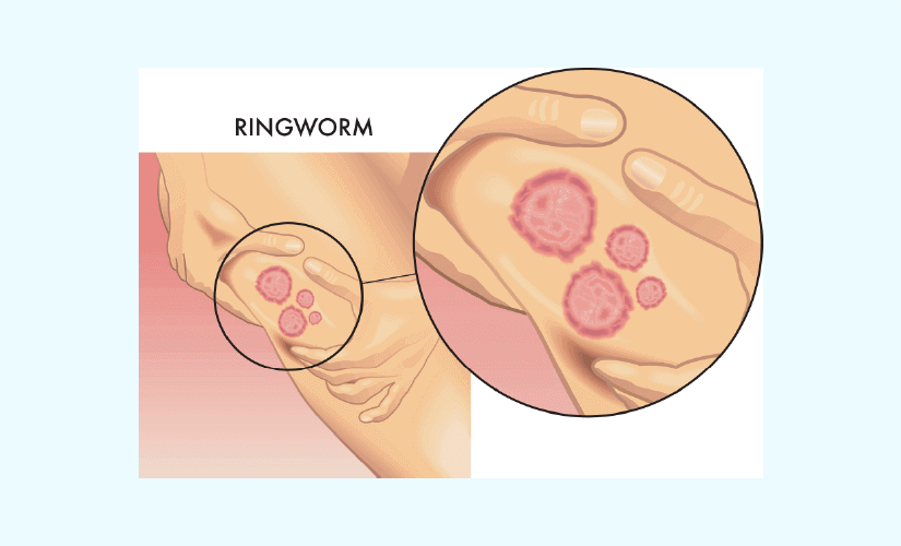 Contact dermatitis: causes, symptoms and treatment