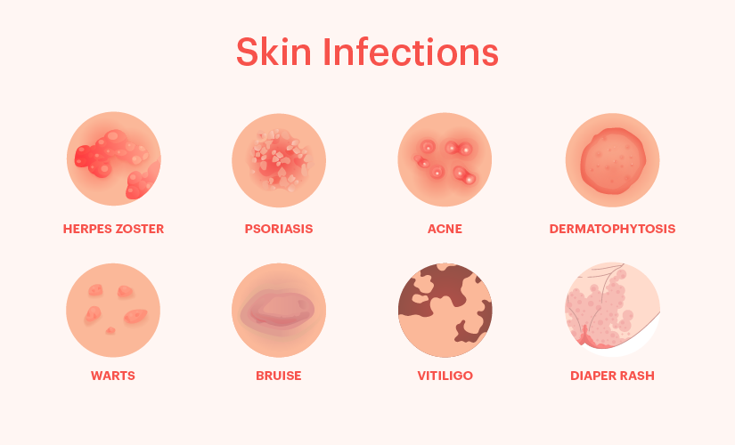 Types of Skin infections