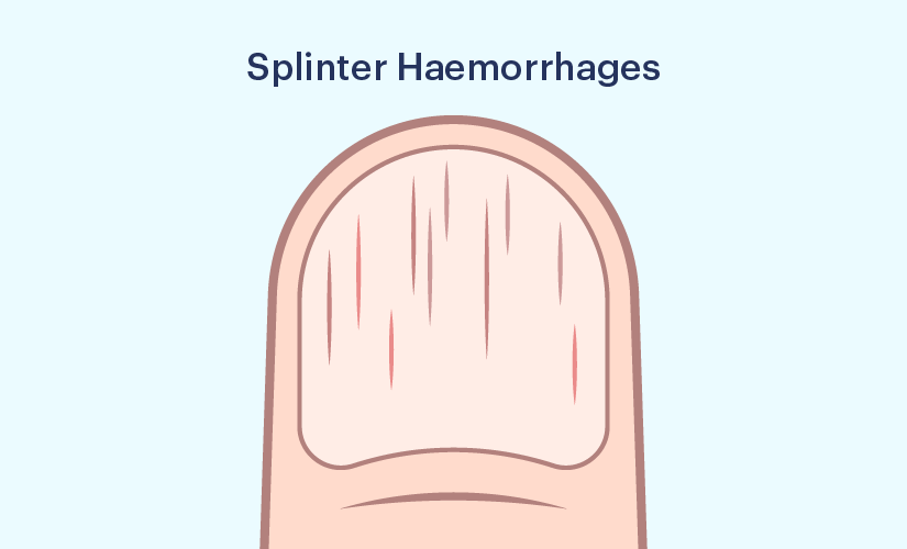 Nails, Splinter Hemorrhages In – Gluten Free Works: TREATMENT GUIDE