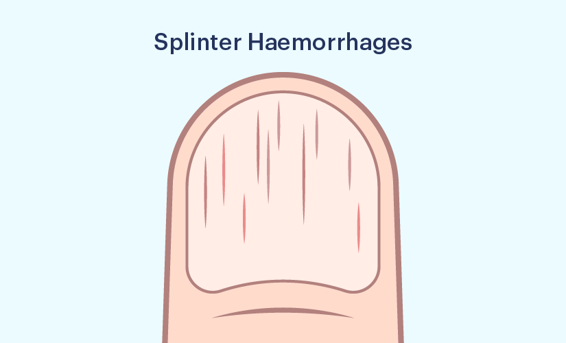 Most Common Blood Clot Symptoms: Fever, Swollen Skin, Foot or Calf Pain,  Tenderness of the Skin, Rapid or Irregular Heartbeat, Feeling Dizzy and ...  and Mysterious Cough, Discoloration by - Amazon.ae