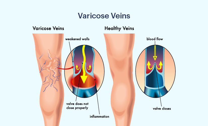 Varicose Veins Laser Treatment Cost In India