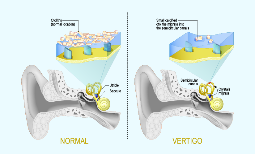 Dizziness and Vertigo - Menopause Signs