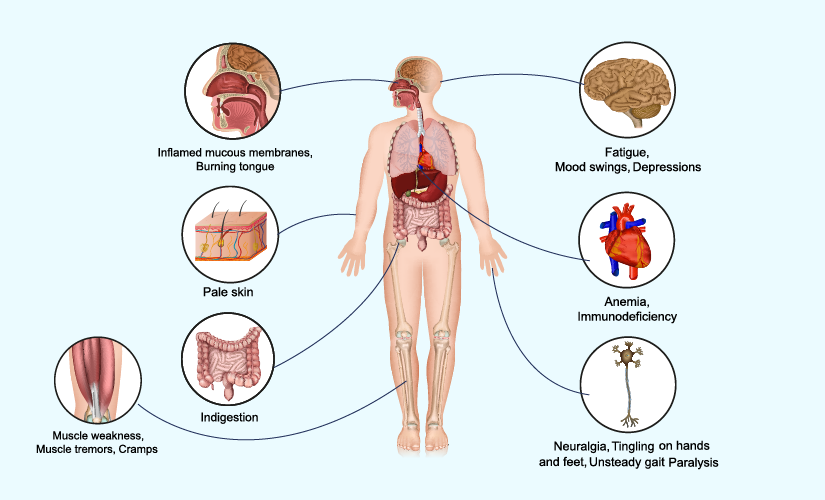 Vitamin B12 Deficiency: Symptoms, Causes, Diagnosis, and Treatment