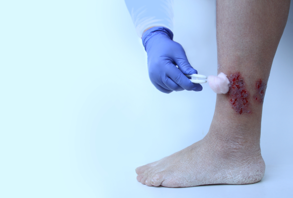 How to Heal Wounds Faster for Diabetics